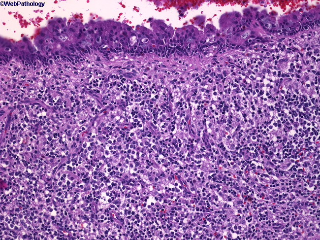 Extranodal NK-T-cell Lymphoma_Nasal1.jpg